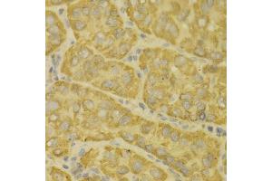 Immunohistochemistry of paraffin-embedded human liver cancer using MAOA antibody (ABIN5970633) at dilution of 1/100 (40x lens). (Monoamine Oxidase A 抗体)
