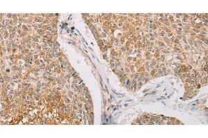 Immunohistochemistry of paraffin-embedded Human lung cancer tissue using STK40 Polyclonal Antibody at dilution 1:40 (STK40 抗体)