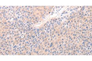 Immunohistochemistry of paraffin-embedded Human liver cancer tissue using ACO1 Polyclonal Antibody at dilution 1:50 (Aconitase 1 抗体)