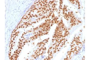 Formalin-fixed, paraffin-embedded human Prostate (PIN) stained with FOXA1 Mouse Monoclonal Antibody (FOXA1/1516).
