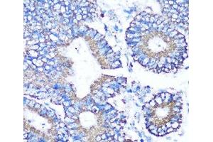 Immunohistochemistry of paraffin-embedded Human colon carcinoma using MMP16 Polyclonal Antibody at dilution of 1:100 (40x lens). (MMP16 抗体)