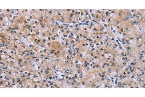 Immunohistochemistry of paraffin-embedded Human prostate cancer using SLC1A6 Polyclonal Antibody at dilution of 1:40 (SLC1A6 抗体)