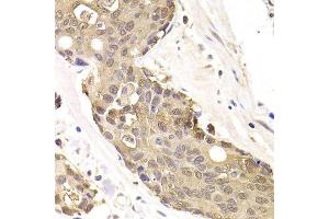 Immunohistochemistry of paraffin-embedded human colon carcinoma using FKBP4 Antibody.