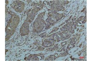 Immunohistochemistry (IHC) analysis of paraffin-embedded Human Breast Carcicnoma using GRP78/Bip Mouse Monoclonal Antibody diluted at 1:200. (GRP78 抗体)