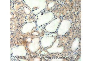 Immunohistochemistry of Human thyroid cancer using AGRN Polyclonal Antibody at dilution of 1:50 (AGRN 抗体)