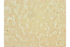 Immunohistochemistry of paraffin-embedded human liver cancer using ABIN7149722 at dilution of 1:100