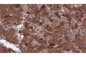 ABIN6277317 at 1/100 staining Human liver cancer tissue by IHC-P. (CNTF Receptor alpha 抗体  (Internal Region))