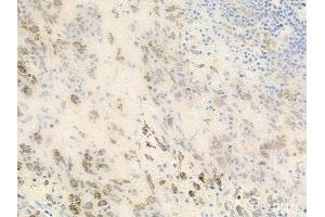 ABIN6262527 and ABIN6278482 at 1/100 staining human melanoma by IHC-P. (IL32 抗体  (Internal Region))