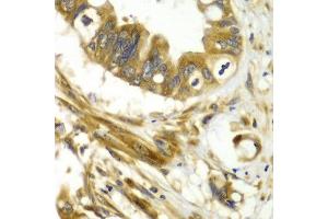 Immunohistochemistry of paraffin-embedded human liver cancer using GBP1 antibody at dilution of 1:100 (x40 lens).