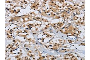 The image on the left is immunohistochemistry of paraffin-embedded Human thyroid cancer tissue using ABIN7190315(CMTM8 Antibody) at dilution 1/40, on the right is treated with synthetic peptide. (CMTM8 抗体)