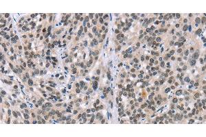 Immunohistochemistry of paraffin-embedded Human esophagus cancer tissue using ADNP Polyclonal Antibody at dilution 1:50 (ADNP 抗体)