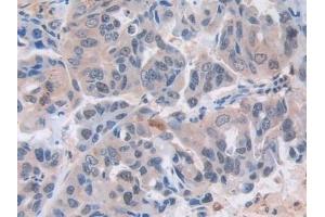 Detection of MX1 in Human Breast cancer Tissue using Polyclonal Antibody to Myxovirus Resistance 1 (MX1) (MX1 抗体  (AA 80-342))