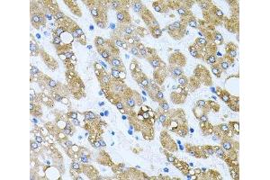 Immunohistochemistry of paraffin-embedded Human liver damage using TOB2 Polyclonal Antibody at dilution of 1:100 (40x lens). (TOB2 抗体)