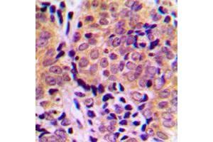 Immunohistochemical analysis of 4EBP1 (pT46) staining in human breast cancer formalin fixed paraffin embedded tissue section. (eIF4EBP1 抗体  (N-Term, pSer46))