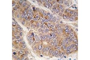 IHC analysis of FFPE human hepatocarcinoma tissue stained with Apolipoprotein A-II antibody (APOA2 抗体  (AA 28-56))