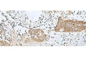 Immunohistochemistry of paraffin-embedded Human esophagus cancer tissue using SNRPD1 Polyclonal Antibody at dilution of 1:70(x200) (SNRPD1 抗体)