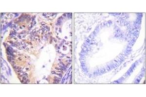Immunohistochemistry analysis of paraffin-embedded human colon carcinoma tissue, using PAK1 (Ab-212) Antibody. (PAK1 抗体  (AA 178-227))