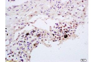 Formalin-fixed and paraffin embedded human lung carcinoma labeled with Rabbit Anti TNFAIP3/A20 Polyclonal Antibody, Unconjugated  at 1:200 followed by conjugation to the secondary antibody and DAB staining (TNFAIP3 抗体  (AA 51-150))
