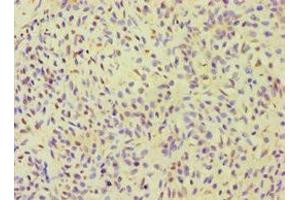 Immunohistochemistry of paraffin-embedded human breast cancer using ABIN7155980 at dilution of 1:100 (ALOXE3 抗体  (AA 1-280))