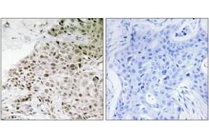 Immunohistochemistry analysis of paraffin-embedded human breast carcinoma tissue, using TAF13 Antibody.