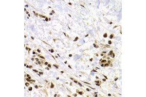 Immunohistochemistry of paraffin-embedded human kidney cancer using SUMO4 Antibody (ABIN5971586) at dilution of 1/200 (40x lens). (SUMO4 抗体)