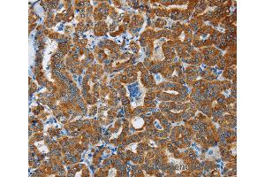 Immunohistochemistry of Human liver cancer using FLCN Polyclonal Antibody at dilution of 1:40 (FLCN 抗体)