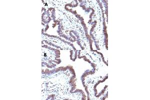 Immunohistochemical staining (Formalin-fixed paraffin-embedded sections) of human ovarian cancer (A, B) with FBXO5 monoclonal antibody, clone EMI1/1176 . (FBXO5 抗体  (AA 1-250))
