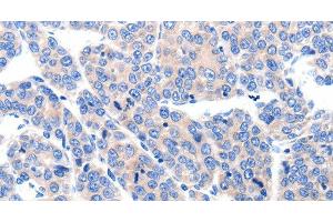 Immunohistochemistry of paraffin-embedded Human ovarian cancer tissue using KCNH8 Polyclonal Antibody at dilution 1:50 (KCNH8 抗体)