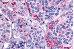 Human Thyroid, Medullary Carcinoma (formalin-fixed, paraffin-embedded) stained with CALCR antibody ABIN213557 at 20 ug/ml followed by biotinylated goat anti-rabbit IgG secondary antibody ABIN481713, alkaline phosphatase-streptavidin and chromogen. (Calcitonin Receptor 抗体  (C-Term))