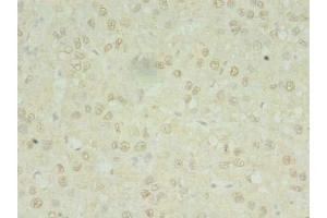 Immunohistochemistry of paraffin-embedded human liver cancer using ABIN7142391 at dilution of 1:100 (MRPL3 抗体  (AA 201-348))