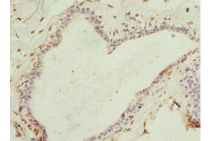 Immunohistochemistry of paraffin-embedded human breast cancer using ABIN7167073 at dilution of 1:100 (HBXIP 抗体  (AA 1-91))