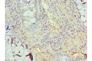 Immunohistochemistry of paraffin-embedded human colon cancer using ABIN7153379 at dilution of 1:100 (TDG 抗体  (AA 141-410))