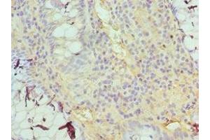Immunohistochemistry of paraffin-embedded human colon cancer using ABIN7153379 at dilution of 1:100