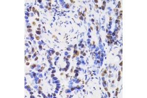 Immunohistochemistry of paraffin-embedded human lung cancer using HDGF Antibody. (HDGF 抗体  (AA 1-240))