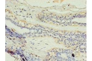 Immunohistochemistry of paraffin-embedded human breast cancer using ABIN7154147 at dilution of 1:100 (GK2 抗体  (AA 2-553))