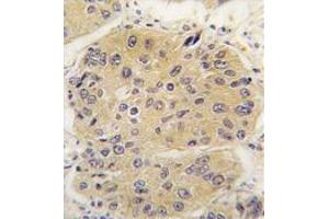 Formalin-Fixed, Paraffin-Eembedded Human lung carcinoma tissue stained with EIF4A1 Antibody (N-term),which was peroxidase-conjugated to the secondary antibody, followed by DAB staining. (EIF4A1 抗体  (N-Term))
