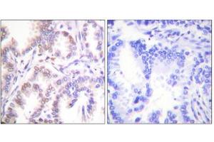 Immunohistochemistry analysis of paraffin-embedded human lung carcinoma tissue using CDK7 antibody. (CDK7 抗体  (C-Term))