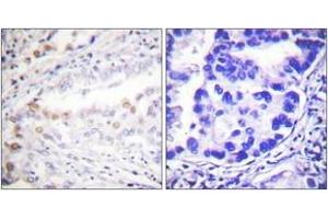 Immunohistochemistry analysis of paraffin-embedded human lung carcinoma tissue, using Uba2 Antibody. (UBA2 抗体  (AA 591-640))