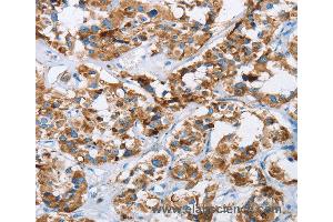 Immunohistochemistry of Human cervical cancer using HINT2 Polyclonal Antibody at dilution of 1:40 (HINT2 抗体)