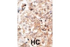 Formalin-fixed and paraffin-embedded human cancer tissue reacted with the primary antibody, which was peroxidase-conjugated to the secondary antibody, followed by DAB staining. (Osteocalcin 抗体  (N-Term))