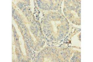 Immunohistochemistry of paraffin-embedded human endometrial cancer using ABIN7175017 at dilution of 1:100 (C12orf49 抗体  (AA 34-205))