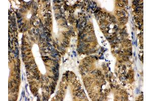IHC(P): Human Intestinal Cancer Tissue (MAPK13 抗体  (C-Term))