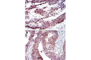 Immunohistochemical analysis of paraffin-embedded human ovarian cancer (A) and human rectum cancer (B) tissues using CYP1A1 monoclonal antibody, clone 6G5  with DAB staining. (CYP1A1 抗体)