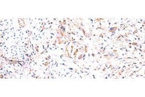 Immunohistochemistry of paraffin-embedded Human cervical cancer tissue using PHKG2 Polyclonal Antibody at dilution of 1:60(x200)