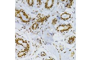 Immunohistochemistry of paraffin-embedded human breast cancer using SNRNP70 antibody. (SNRNP70 抗体  (AA 150-250))