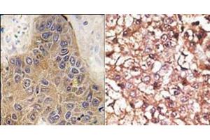 (LEFT)Formalin-fixed and paraffin-embedded human hepatocarcinoma tissue reacted with CHIP (STUB1) antibody (C-term), which was peroxidase-conjugated to the secondary antibody, followed by DAB staining. (STUB1 抗体  (C-Term))