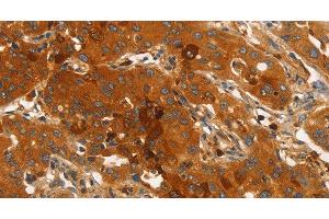 Immunohistochemistry of paraffin-embedded Human lung cancer using ORM2 Polyclonal Antibody at dilution of 1:40 (Orosomucoid 2 抗体)