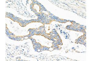 ABIN6259122 and ABIN6275275 at 1/100 staining Human colorectal cancer by IHC-P.