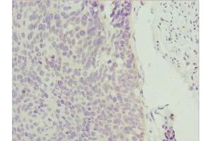 Immunohistochemistry of paraffin-embedded human cervical cancer using ABIN7176006 at dilution of 1:100 (ZNF187 抗体  (AA 239-478))