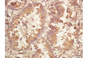 Formalin-fixed and paraffin embedded human lung carcinoma labeled with Rabbit Anti-Caspase-9 (Ser196) Polyclonal Antibody, Unconjugated (ABIN756922) at 1:200 followed by conjugation to the secondary antibody and DAB staining (Caspase 9 抗体  (pSer196))